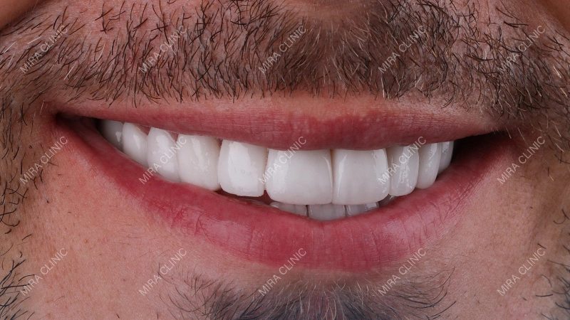 Dental implant Final Result